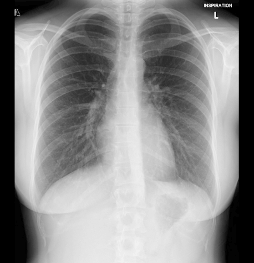 heart XRAY